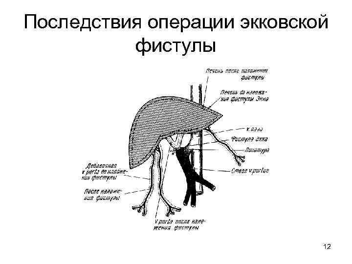 Последствия операции экковской фистулы 12 