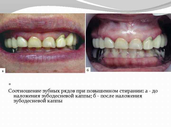 Ортопедическое лечение всех форм стираемости зубов thumbnail