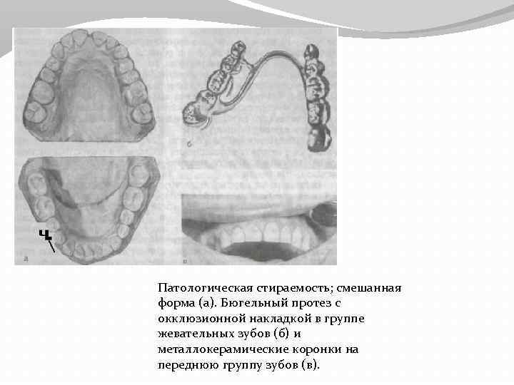 Патологическая стираемость; смешанная форма (а). Бюгельный протез с окклюзионной накладкой в группе жевательных зубов