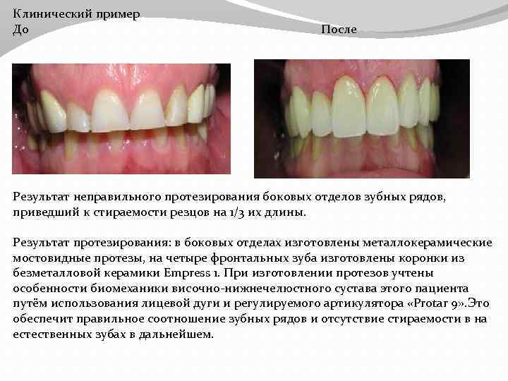 Клинический пример До После Результат неправильного протезирования боковых отделов зубных рядов, приведший к стираемости