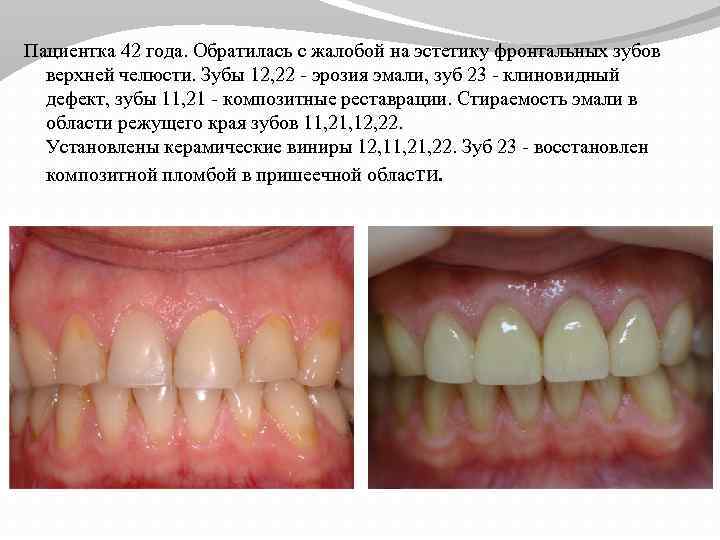 Пациентка 42 года. Обратилась с жалобой на эстетику фронтальных зубов верхней челюсти. Зубы 12,