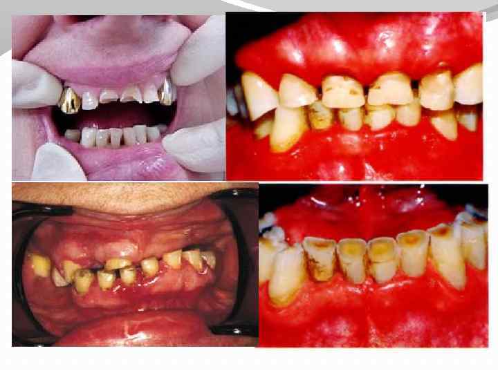 Ортопедические методы лечения патологической стираемости зубов