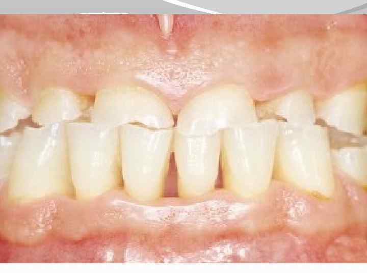 Ортопедическое лечение при повышенной стираемости зубов