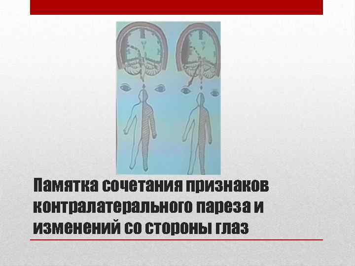 Памятка сочетания признаков контралатерального пареза и изменений со стороны глаз 