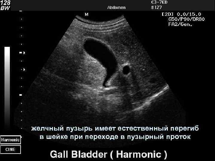 желчный пузырь имеет естественный перегиб в шейке при переходе в пузырный проток 