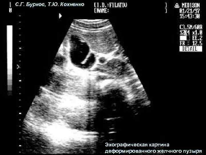 С. Г. Бурков, Т. Ю. Кохненко Эхографическая картина деформированного желчного пузыря 