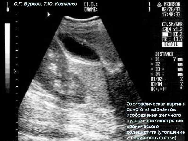 С. Г. Бурков, Т. Ю. Кохненко Эхографическая картина одного из вариантов изображения желчного пузыря
