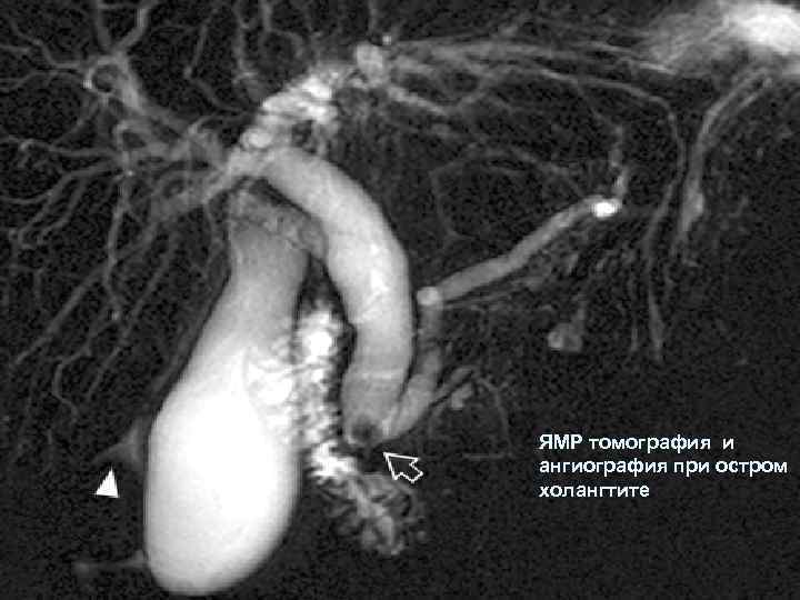 Мрт холангиография. Кт холангиография желчного пузыря. Мрт холангиография желчного пузыря. Магнитная резонансная холангиография. Мрт желчных протоков холангиография.