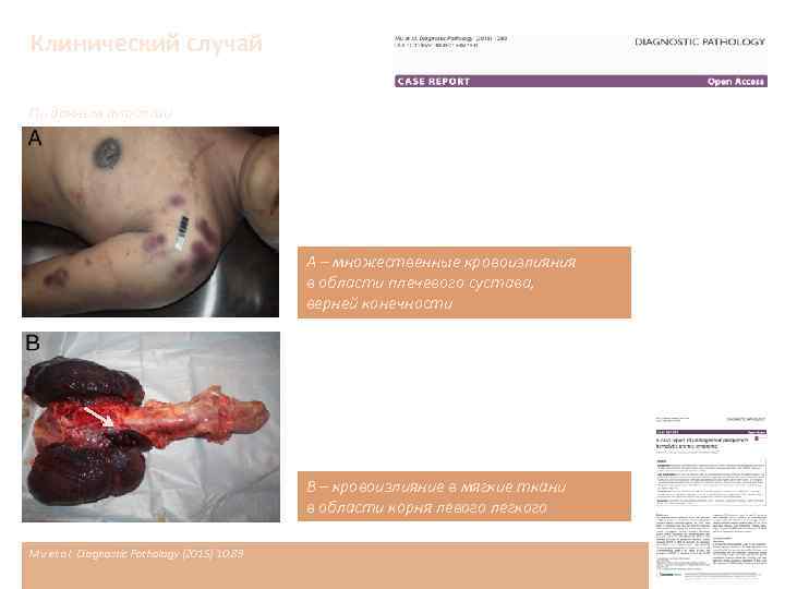 Клинический случай По данным аутопсии А – множественные кровоизлияния в области плечевого сустава, верней