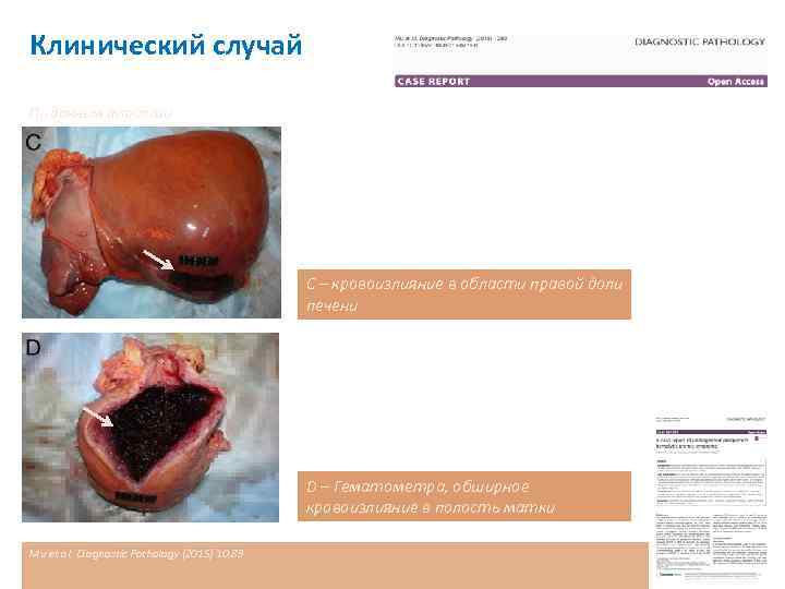Клинический случай По данным аутопсии С – кровоизлияние в области правой доли печени D