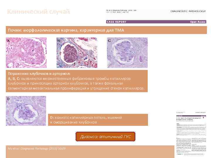 Клинический случай Почки: морфологическая картина, характерная для ТМА Поражение клубочков и артериол: A, B,