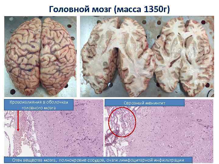 Головной мозг (масса 1350 г) Кровоизлияния в оболочках головного мозга Серозный менингит Отек вещества