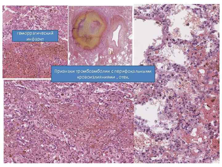 геморрагический инфаркт Признаки тромбоэмболии с перифокальными кровоизлияниями , отек. 