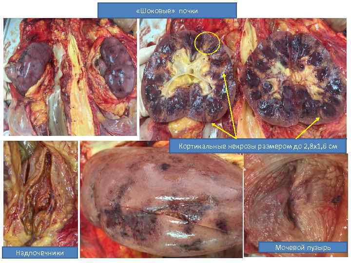  «Шоковые» почки Кортикальные некрозы размером до 2, 8 х1, 6 см Надпочечники Мочевой