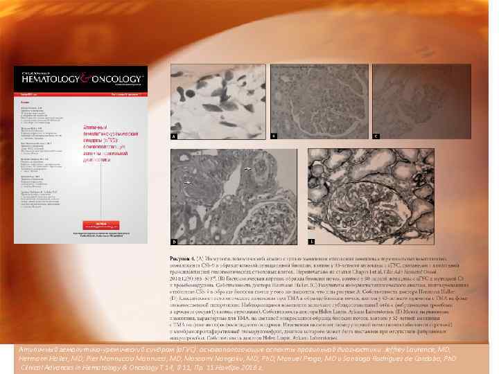 Атипичный гемолитико-уремический синдром (а. ГУС): основополагающие аспекты правильной диагностики. Jeffrey Laurence, MD, Hermann Haller,