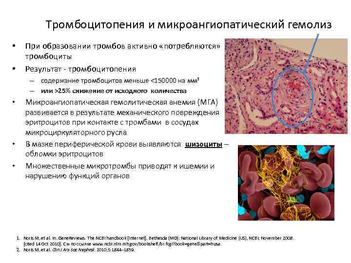 Тромбоцитопения и микроангиопатический гемолиз • • При образовании тромбов активно «потребляются» тромбоциты Результат -