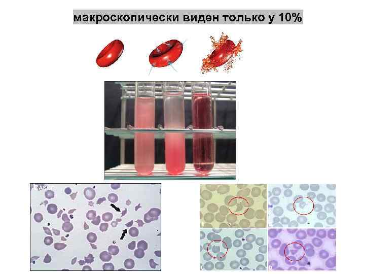 Гемолиз: макроскопически виден только у 10% 