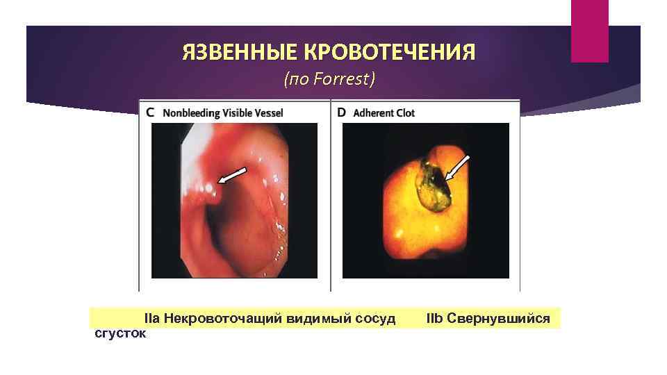 ЯЗВЕННЫЕ КРОВОТЕЧЕНИЯ (по Forrest) IIa Некровоточащий видимый сосуд сгусток IIb Свернувшийся 