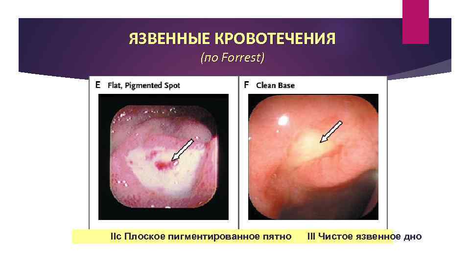 ЯЗВЕННЫЕ КРОВОТЕЧЕНИЯ (по Forrest) IIc Плоское пигментированное пятно III Чистое язвенное дно 