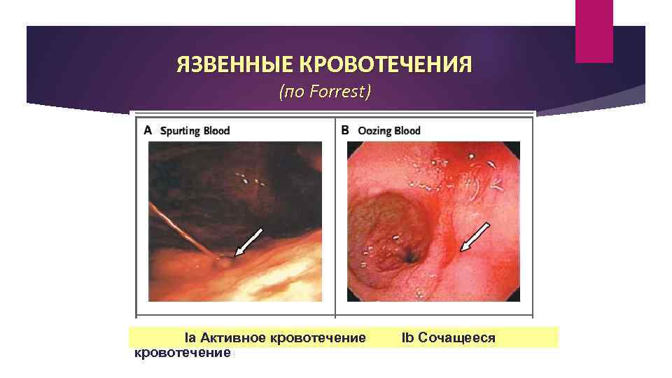 ЯЗВЕННЫЕ КРОВОТЕЧЕНИЯ (по Forrest) Ia Активное кровотечение Ib Сочащееся 