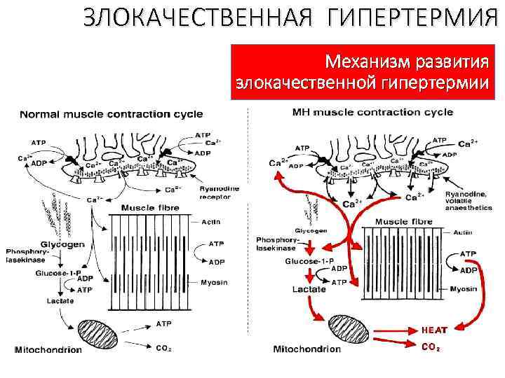 ЗЛОКАЧЕСТВЕННАЯ ГИПЕРТЕРМИЯ Механизм развития злокачественной гипертермии 