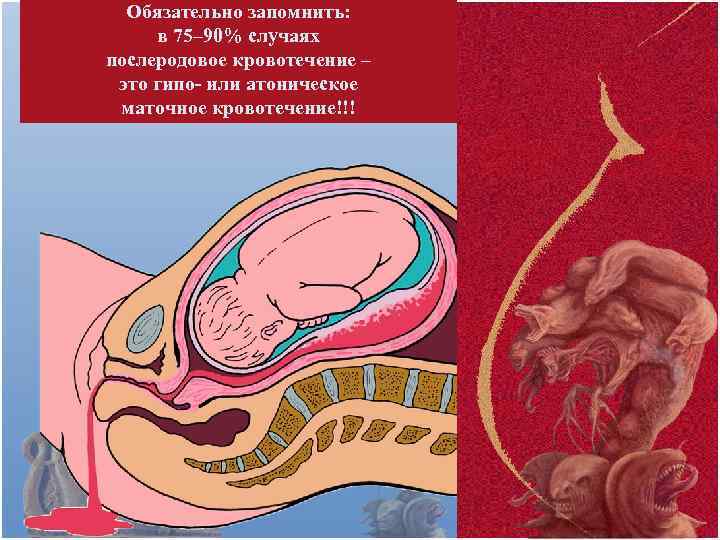 Обязательно запомнить: в 75– 90% случаях послеродовое кровотечение – это гипо- или атоническое маточное