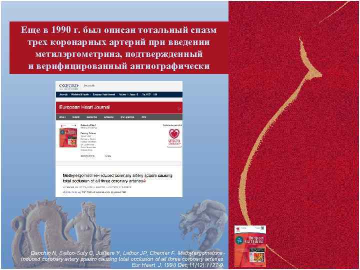 Еще в 1990 г. был описан тотальный спазм трех коронарных артерий при введении метилэргометрина,