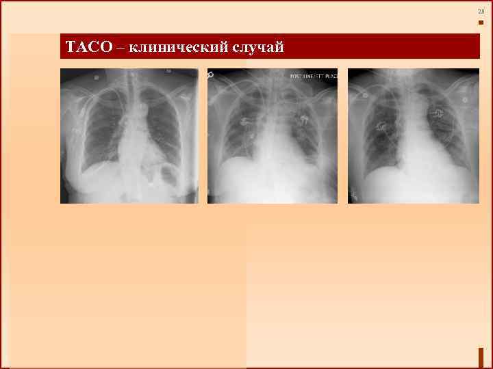 29 TACO – клинический случай 