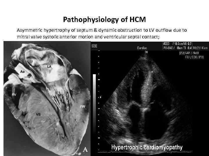 Pathophysiology of HCM Asymmetric hypertrophy of septum & dynamic obstruction to LV outflow due