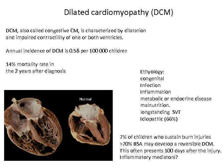 Dilated cardiomyopathy (DCM) DCM, also called congestive CM, is characterized by dilatation and impaired