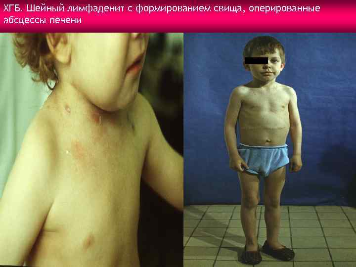 ХГБ. Шейный лимфаденит с формированием свища, оперированные абсцессы печени 