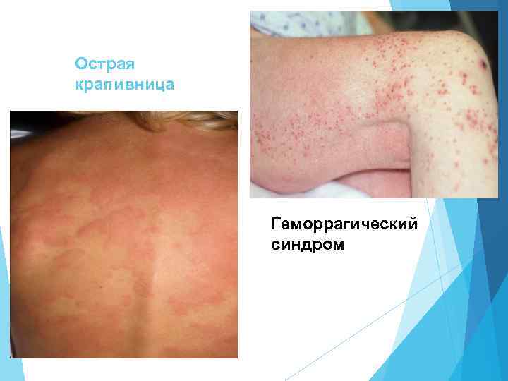 Острая крапивница Геморрагический синдром 