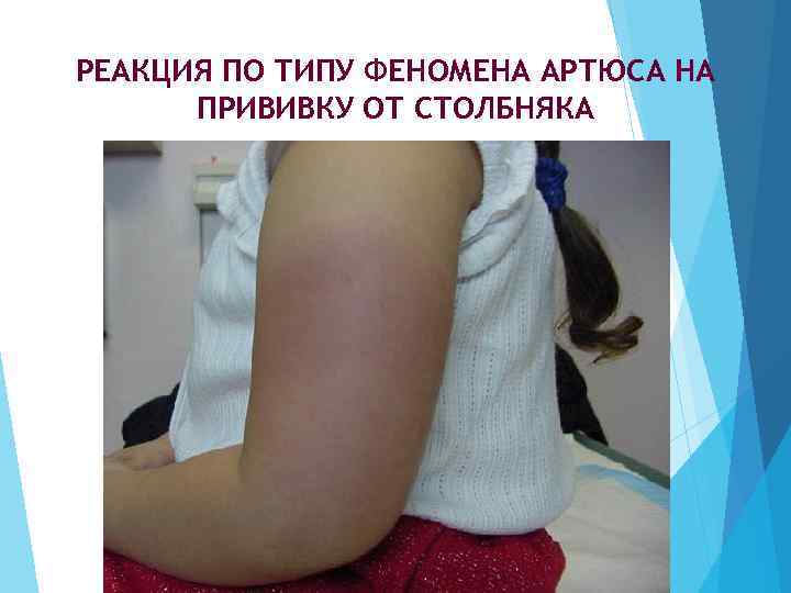 РЕАКЦИЯ ПО ТИПУ ФЕНОМЕНА АРТЮСА НА ПРИВИВКУ ОТ СТОЛБНЯКА 