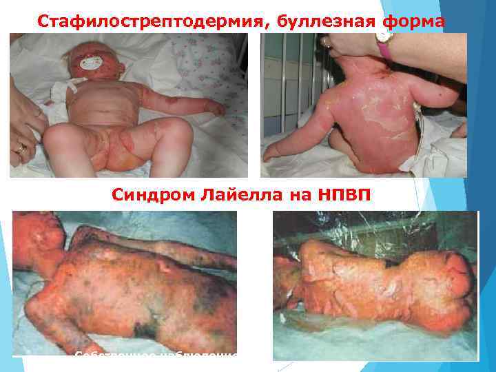 Стафилострептодермия, буллезная форма Синдром Лайелла на НПВП Собственное наблюдение 