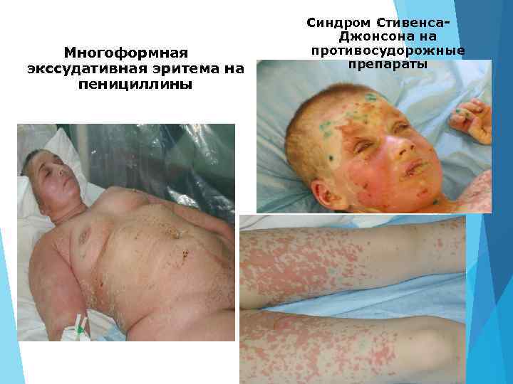 Многоформная экссудативная эритема на пенициллины Синдром Стивенса. Джонсона на противосудорожные препараты 