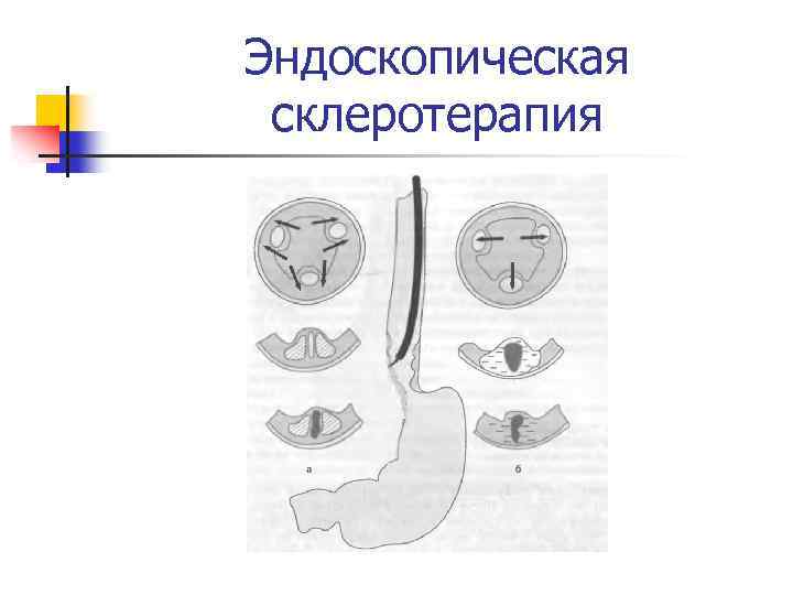 Эндоскопическая склеротерапия 