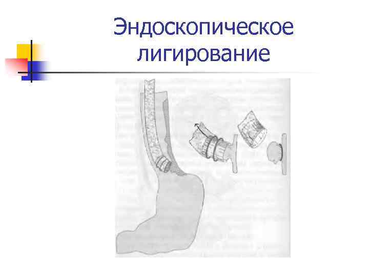 Эндоскопическое лигирование 