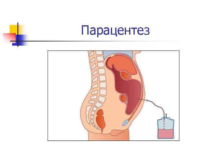 Парацентез 