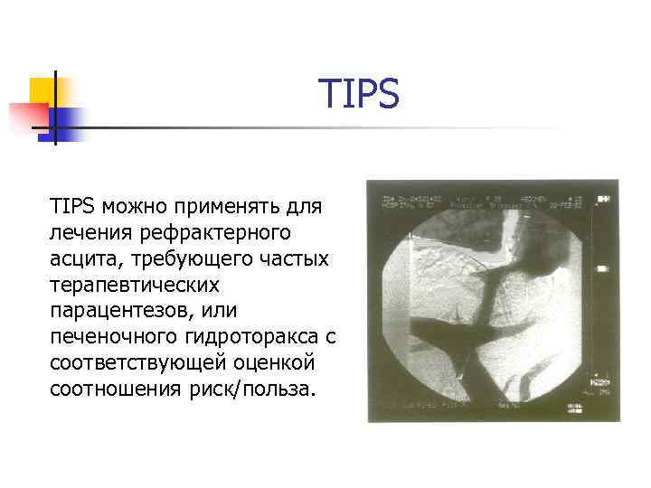 TIPS можно применять для лечения рефрактерного асцита, требующего частых терапевтических парацентезов, или печеночного гидроторакса