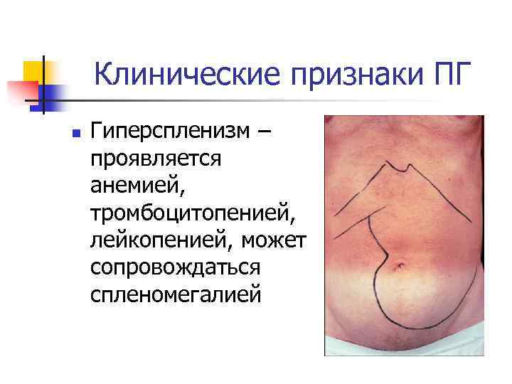 Клинические признаки ПГ n Гиперспленизм – проявляется анемией, тромбоцитопенией, лейкопенией, может сопровождаться спленомегалией 