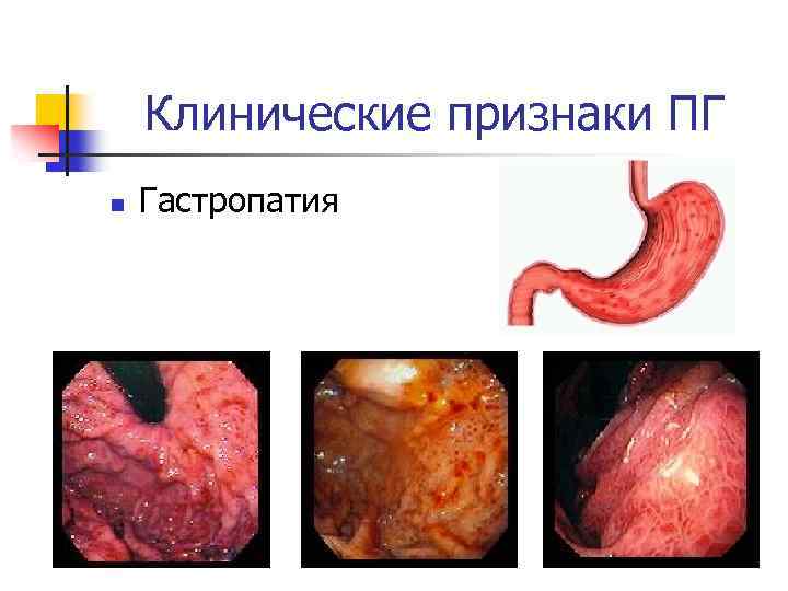 Клинические признаки ПГ n Гастропатия 