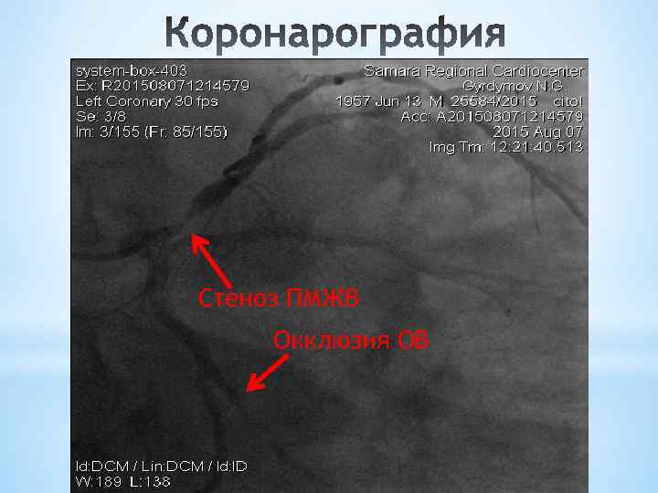 Стеноз ПМЖВ Окклюзия ОВ 