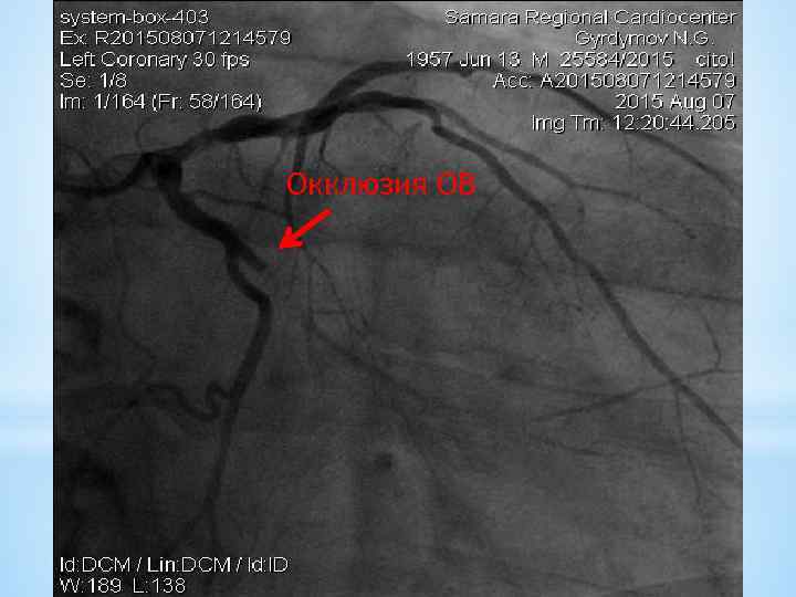 Окклюзия ОВ 