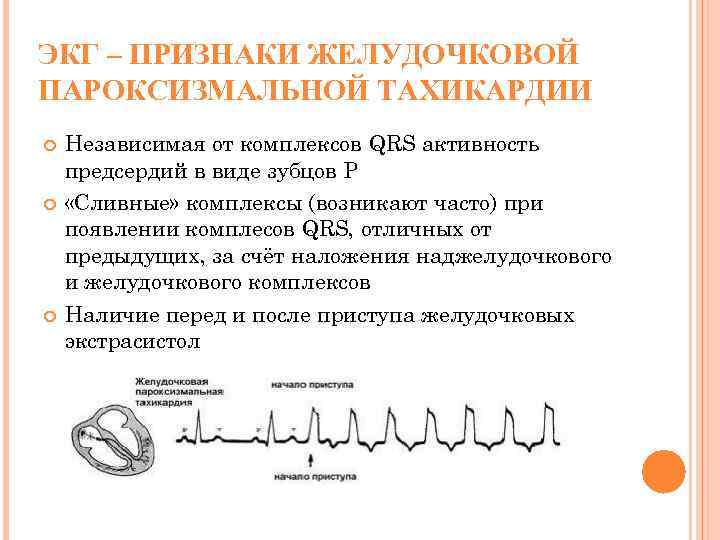 ЭКГ – ПРИЗНАКИ ЖЕЛУДОЧКОВОЙ ПАРОКСИЗМАЛЬНОЙ ТАХИКАРДИИ Независимая от комплексов QRS активность предсердий в виде