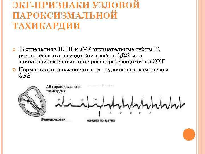 ЭКГ-ПРИЗНАКИ УЗЛОВОЙ ПАРОКСИЗМАЛЬНОЙ ТАХИКАРДИИ В отведениях II, III и a. VF отрицательные зубцы Р',