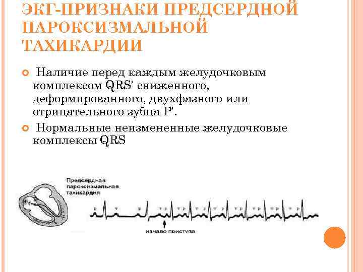 ЭКГ-ПРИЗНАКИ ПРЕДСЕРДНОЙ ПАРОКСИЗМАЛЬНОЙ ТАХИКАРДИИ Наличие перед каждым желудочковым комплексом QRS' сниженного, деформированного, двухфазного или