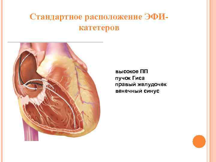 Стандартное расположение ЭФИкатетеров высокое ПП пучок Гиса правый желудочек венечный синус 