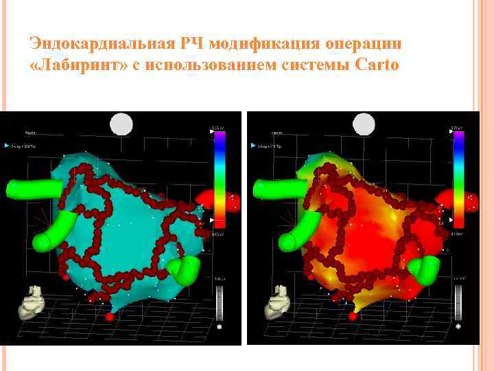 Эндокардиальная РЧ модификация операции «Лабиринт» с использованием системы Carto 
