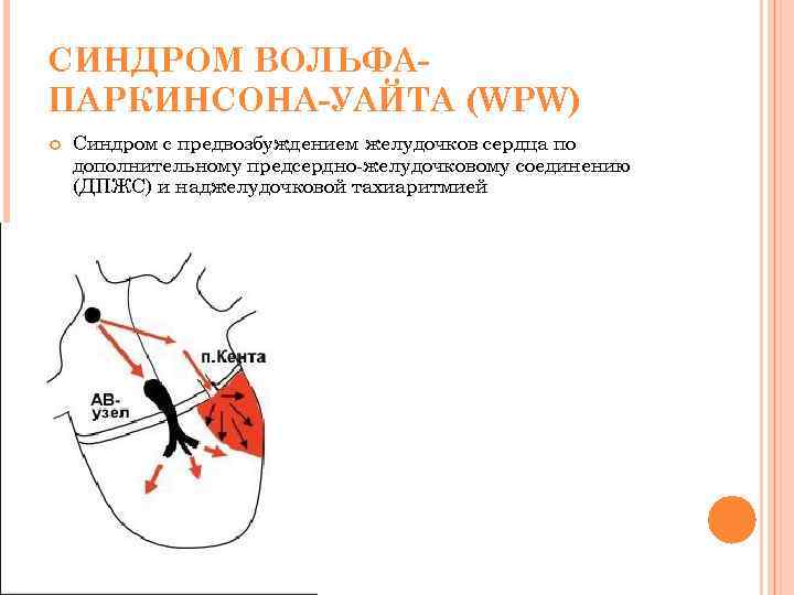 СИНДРОМ ВОЛЬФАПАРКИНСОНА-УАЙТА (WPW) Синдром с предвозбуждением желудочков сердца по дополнительному предсердно-желудочковому соединению (ДПЖС) и