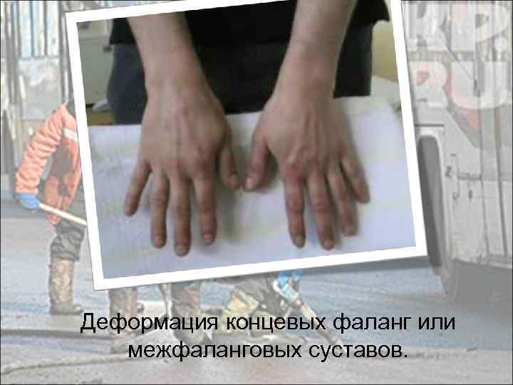 Деформация концевых фаланг или межфаланговых суставов. 